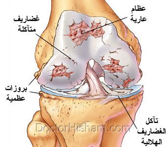 مرض الركبة