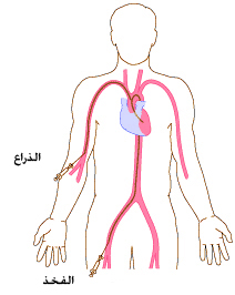 نزف تحت الجلد قسطرة