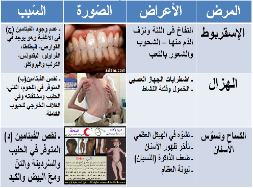 الامراض الناتجة عن سوء التغذية