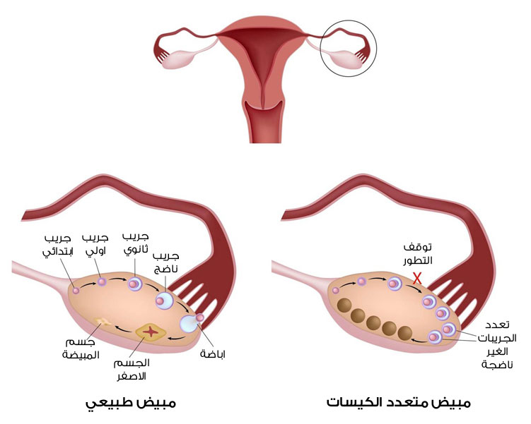 ما هو انتفاخ المبيض