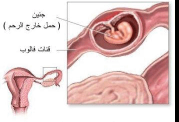 الحمل خارج الرحم