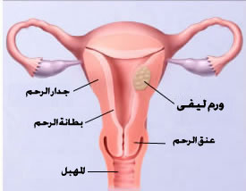 هل الاورام الليفية الرحمية منها عينه