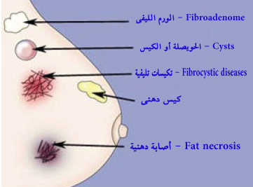 ورم الصدر _ اعراض الاورام