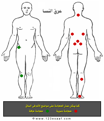 الحجامة لتنشيط الذاكرة