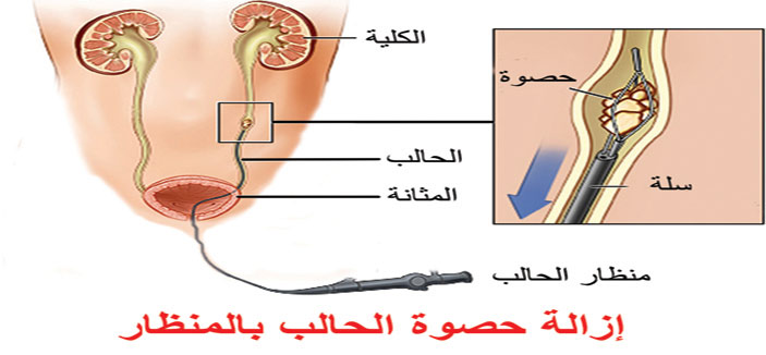 عملية منظار حصوة الحالب