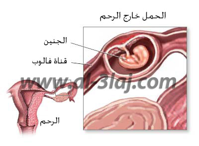 نزول الدم في الشهر الاول من الحمل