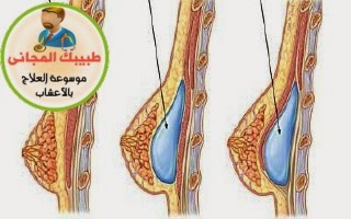 اعشاب طبيعية لتصغير الصدر