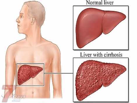 تحليل hcv