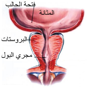 احتفان بروستات _ وعلاجها