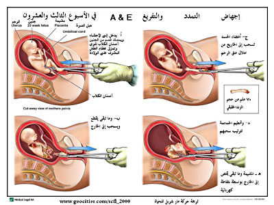 اجهاض الحمل