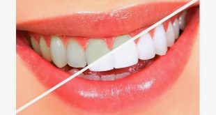 كاللؤلؤ بيضاء اسنان 20160915 406 1 310x165