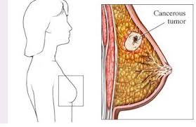 الام الثدي الايمن قبل الدورة