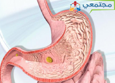 وصفة ايلان قرحة المعدة