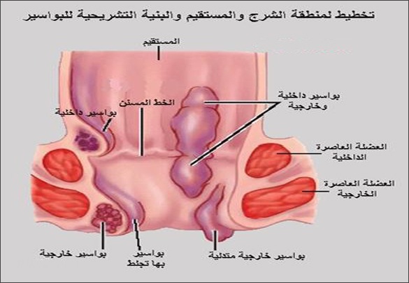 خلات الرصاص والبواسير